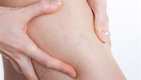 Effective Sclerotherapy Treatments: A Comprehensive Guide to Vein Care and Recovery